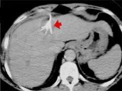 Liver Ablation RFA Needle Probe