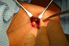 MIP Parathyroid Adenoma