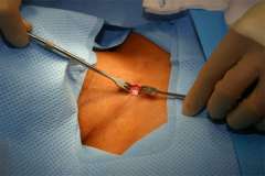MIP Skin Incision
