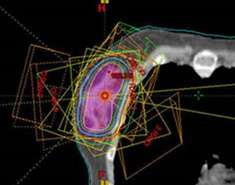 breast external beam