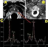 Prostate MRI