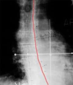 xray