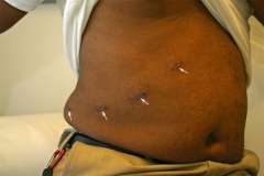 Link, image, scar after laparoscopic adrenal surgery