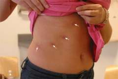Link, image, scar after laparoscopic adrenal surgery