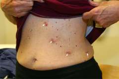 Link, image, scar after laparoscopic adrenal surgery