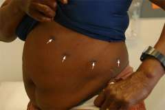 Link, image, scar after laparoscopic adrenal surgery