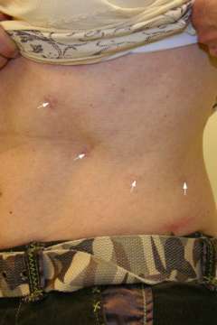 Link, image, scar after laparoscopic adrenal surgery