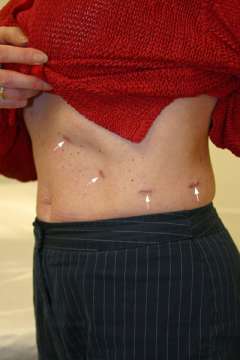 scar after laparoscopic adrenal surgery