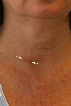 2 weeks after surgery