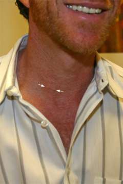 2 weeks after surgery