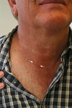 2 weeks after surgery