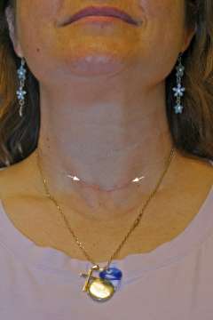 Scar appearance 3 months after surgery