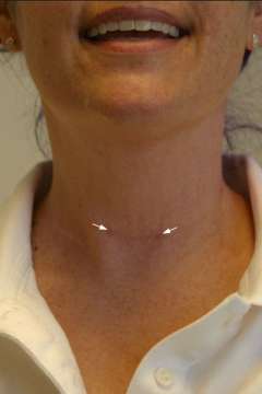 Scar appearance 3 months after surgery