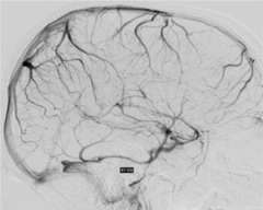 Sinus Thrombosis Figure 1: Normal