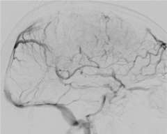 Sinus Thrombosis