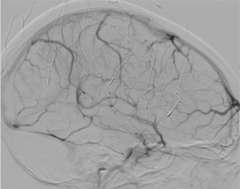 ST - After Treatment