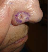 nose cancer