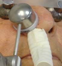 basal cell on nose