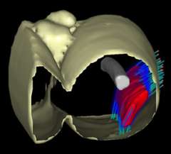 UCLA brachytherapy soft tissue sarcoma