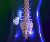 graphic of an Intrathecal Baclofen Pump