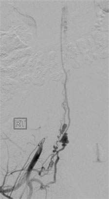 Multiple arteries feeding the spinal AVM. There are aneurysms in the feeding arteries.