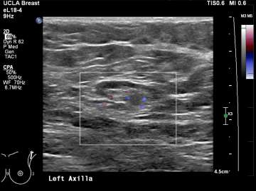 Case: Axillary Lymphadenopathy Figure 2