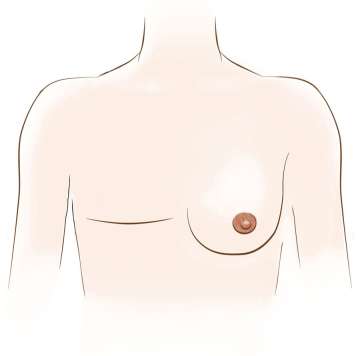 Simple-Mastectomy