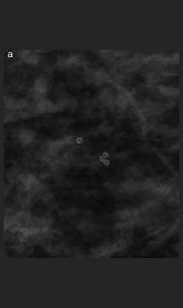 Skin calcifications