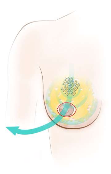 Illustrative diagram of the incision and removal of tissue during mascetomy.