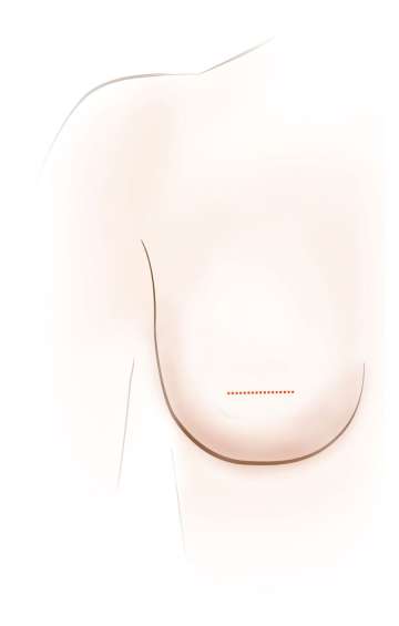 Illustrative diagram of inserting an breast implant