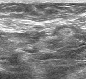 Case: Accessory Breast Tissue Figure 2