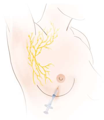 Illustration of needle injection into breast