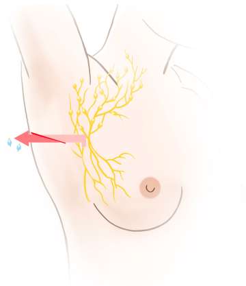 Illustration of nodes removed from under the armpit.
