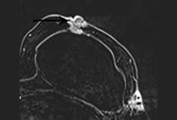 Breast MRI Findings: Post-surgical Findings