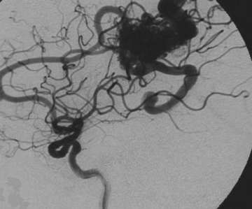 Figure 5 - Before Treatment