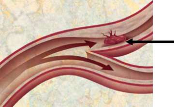 Acute Stroke Figure 2