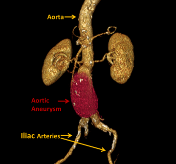 Aortic Aneurysm Diagram