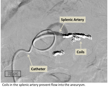 medical illustration of Coils in the splenic artery prevent flow into the aneurysm