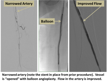 Narrowed artery. Vessel is "opened" with balloon angioplasty. Flow in the artery is improved