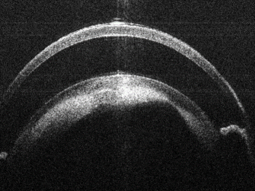 Bioptigen sdOCT Anterior Segment Image