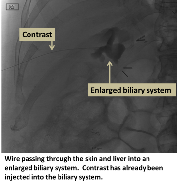 Wire passing thru the skin and liver into an enlarged biliary system. Contrast already injected into biliary system