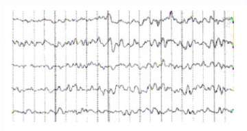 Normal EEG