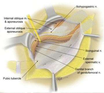 Figure showing Chronic Groin Pain