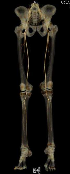 Lower Extremity Runoff