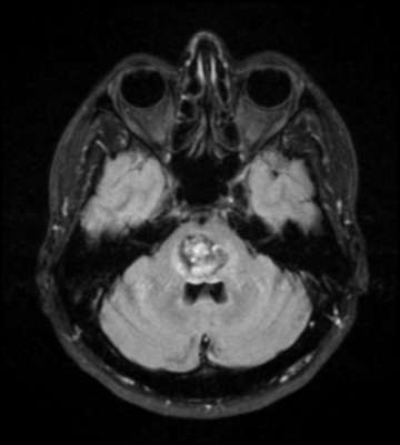 Cavernous Angioma