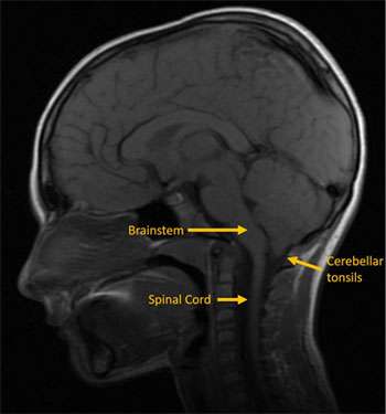 Chiari Malformation 1