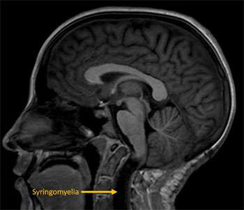 Chiari Malformation 2