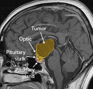 Cranio Sag Preop Before Surgery