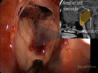 Cranio endoscopic