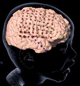 brain mapping - Epilepsy